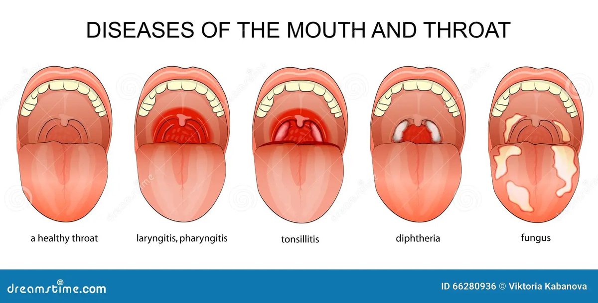Uvula Pathologies & AI Diagnosis Powers Faster More Accurate Detection